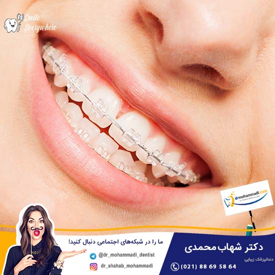 ارتودنسی سرامیکی و هر آنچه باید درباره آن بدانیم - کلینیک دندانپزشکی دکتر شهاب محمدی